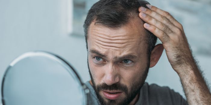 hair_translpantation