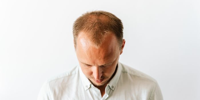hair_loss