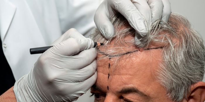 hair_transplant_surgery
