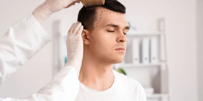 hair_transplantation