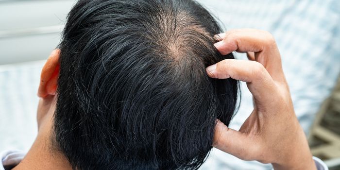 non_genetic_hair_loss